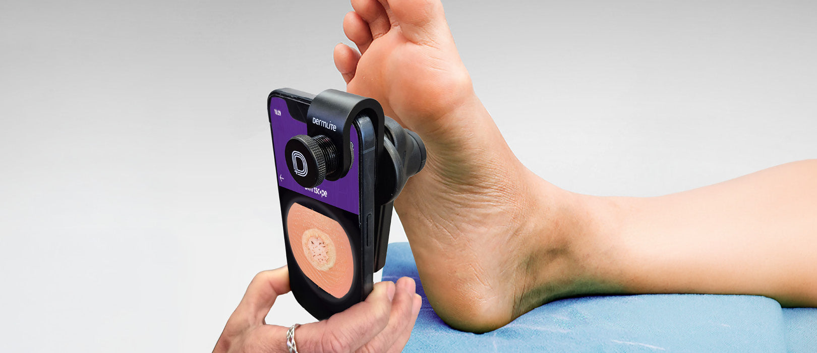 Emblation Announces Strategic Partnership with DermLite to Assist Diagnosis and Documentation of Skin Conditions Treated by Swift Technology
